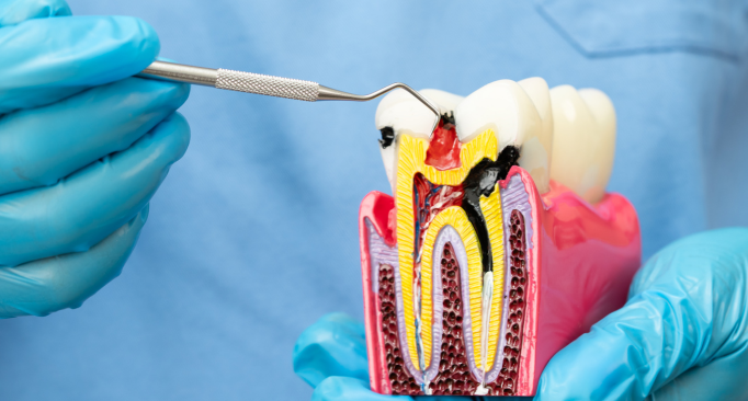 Signs You Need a Root Canal Treatment