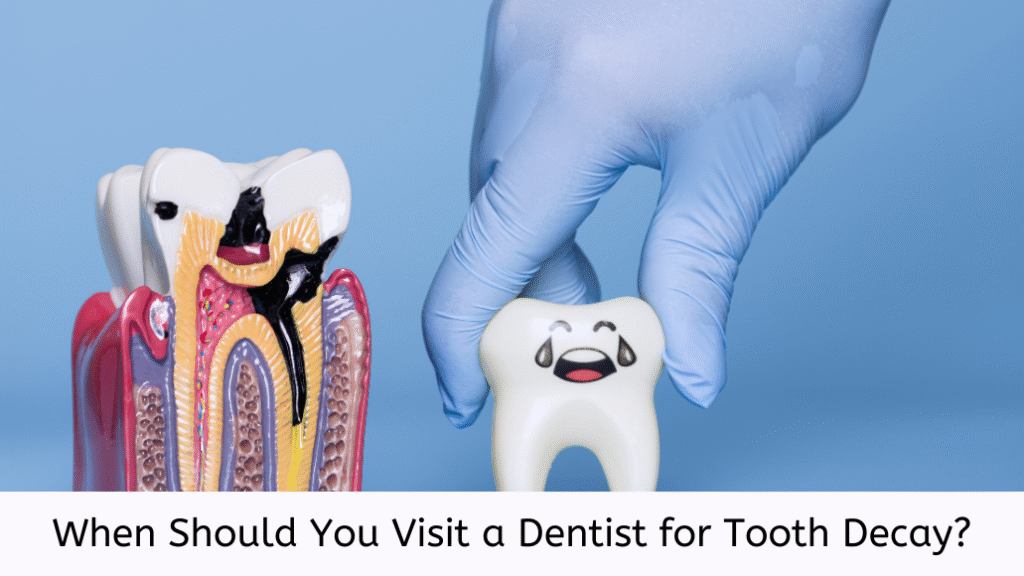 When Should You Visit a Dentist for Tooth Decay?